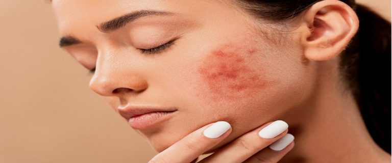Home remedies for pigmentation