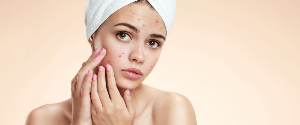 6 Face Packs For Acne: Do-it-yourself Recipes