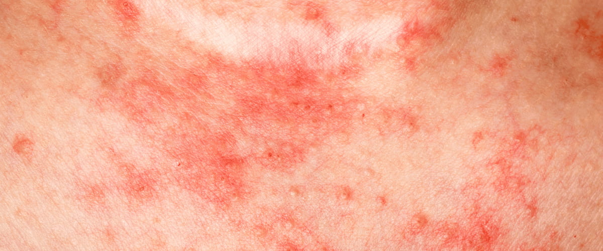 Treatment For Shingles: Effective Natural Home
Remedies