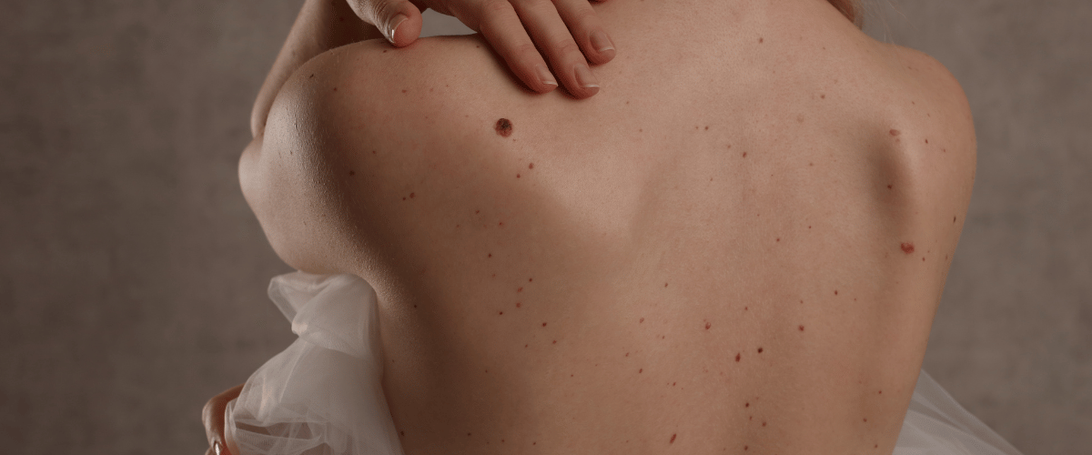 cost of removing skin tags